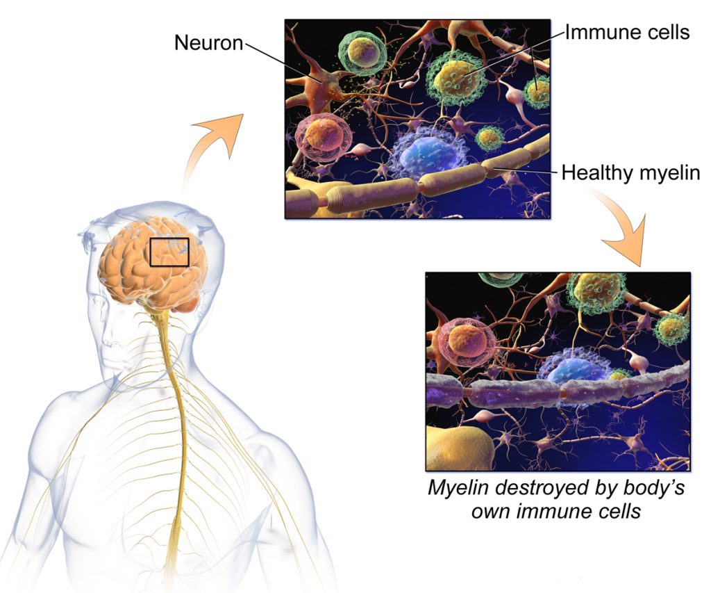 Illustration of how autoimmune disease MS affects the brain and the central nervous system.